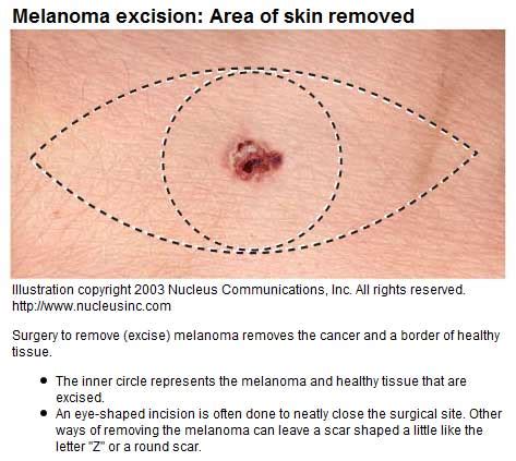 melanoma in situ excision scar